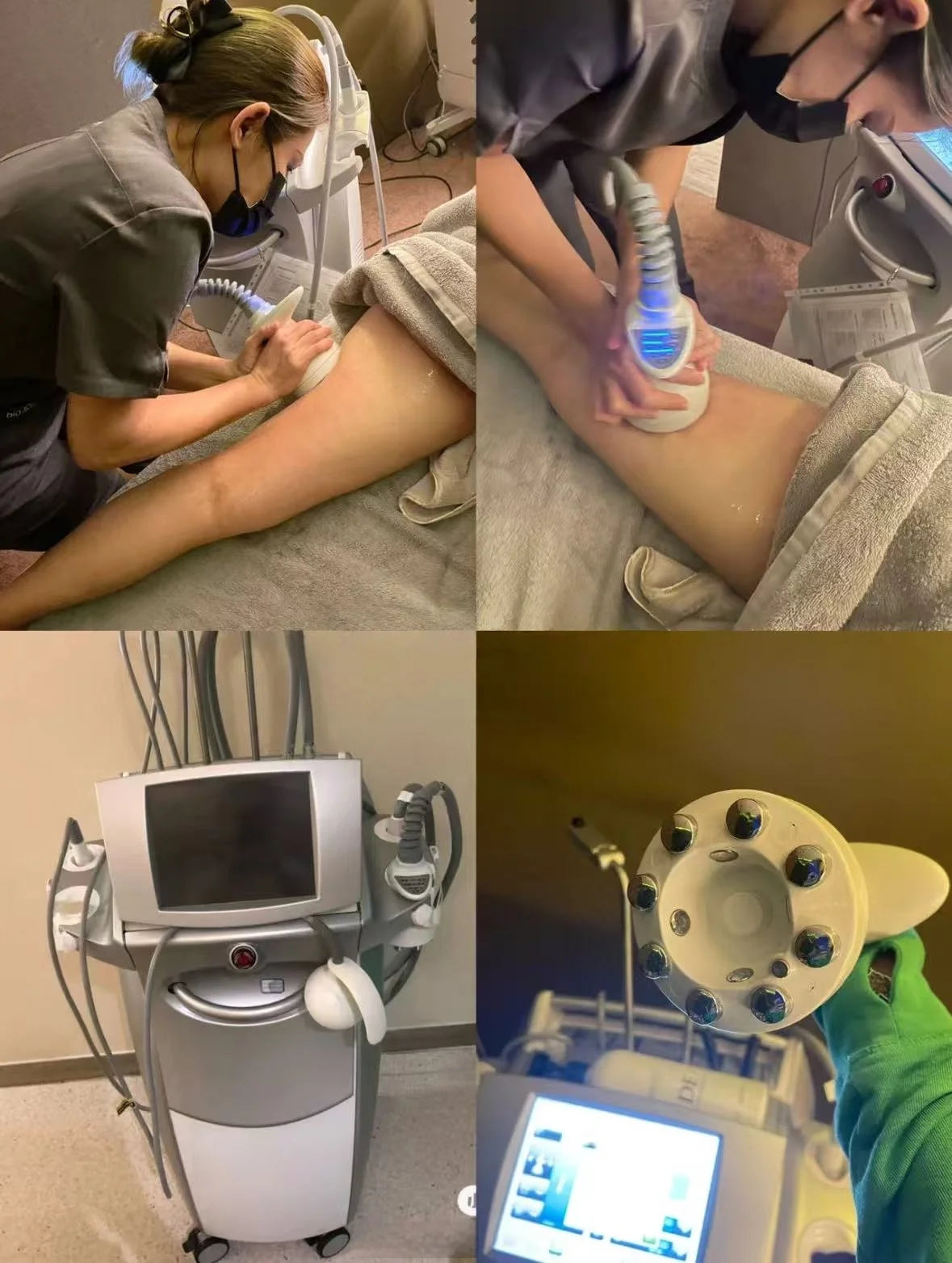 SLyric Venus Legacy Style Radio Frequency Skin Lifting Device